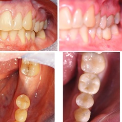 Tooth dental Implant before and after Dental Images DENTOLOGY Boston 