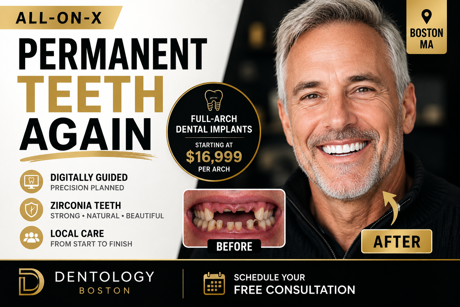 All-on-X full-arch implant bridge illustrating emergency care for broken temporary teeth after treatment overseas